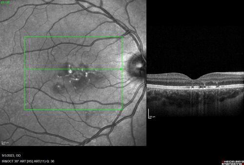 Laser pointer maculopathy
11 year old male When school started the patient noticed that he was having trouble reading and seeing out of both eyes. There are no retinal diseases in the family.
VA OD: sc20/25
VA OS: sc20/40 
TP: OD:19 OS:18 

The FOBSERD ZK-9318 laser pointer is a long range green beam high power flashlight. It has an average power of 60-90 mw. 
You can buy the ZK-9318 laser pointer on Amazon

I also found this:
The FOBSERD ZK-9318 laser pointer is a class III laser with a 532nm wavelength and can be seen up to 1 mile away. It has a maximum power output of 5mW and creates a low-power visible laser beam.

One review on amazon says this:
 Powerful
By Savvy Logic in the United States on March 17, 2023
I measured the wattage at about 150 MW on an optical Power Meter
