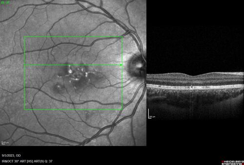 Laser pointer maculopathy
11 year old male When school started the patient noticed that he was having trouble reading and seeing out of both eyes. There are no retinal diseases in the family.
VA OD: sc20/25
VA OS: sc20/40 
TP: OD:19 OS:18 

The FOBSERD ZK-9318 laser pointer is a long range green beam high power flashlight. It has an average power of 60-90 mw. 
You can buy the ZK-9318 laser pointer on Amazon

I also found this:
The FOBSERD ZK-9318 laser pointer is a class III laser with a 532nm wavelength and can be seen up to 1 mile away. It has a maximum power output of 5mW and creates a low-power visible laser beam.

One review on amazon says this:
 Powerful
By Savvy Logic in the United States on March 17, 2023
I measured the wattage at about 150 MW on an optical Power Meter
