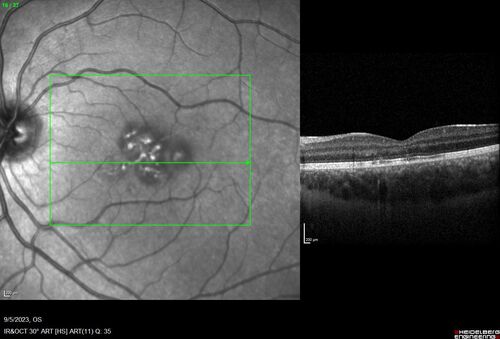Laser pointer maculopathy
11 year old male When school started the patient noticed that he was having trouble reading and seeing out of both eyes. There are no retinal diseases in the family.
VA OD: sc20/25
VA OS: sc20/40 
TP: OD:19 OS:18 

The FOBSERD ZK-9318 laser pointer is a long range green beam high power flashlight. It has an average power of 60-90 mw. 
You can buy the ZK-9318 laser pointer on Amazon

I also found this:
The FOBSERD ZK-9318 laser pointer is a class III laser with a 532nm wavelength and can be seen up to 1 mile away. It has a maximum power output of 5mW and creates a low-power visible laser beam.

One review on amazon says this:
 Powerful
By Savvy Logic in the United States on March 17, 2023
I measured the wattage at about 150 MW on an optical Power Meter

