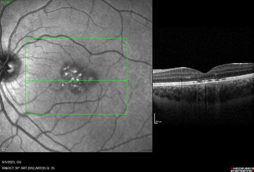 Laser pointer maculopathy
11 year old male When school started the patient noticed that he was having trouble reading and seeing out of both eyes. There are no retinal diseases in the family.
VA OD: sc20/25
VA OS: sc20/40 
TP: OD:19 OS:18 

The FOBSERD ZK-9318 laser pointer is a long range green beam high power flashlight. It has an average power of 60-90 mw. 
You can buy the ZK-9318 laser pointer on Amazon

I also found this:
The FOBSERD ZK-9318 laser pointer is a class III laser with a 532nm wavelength and can be seen up to 1 mile away. It has a maximum power output of 5mW and creates a low-power visible laser beam.

One review on amazon says this:
 Powerful
By Savvy Logic in the United States on March 17, 2023
I measured the wattage at about 150 MW on an optical Power Meter
