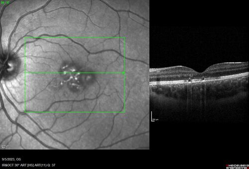 Laser pointer maculopathy
11 year old male When school started the patient noticed that he was having trouble reading and seeing out of both eyes. There are no retinal diseases in the family.
VA OD: sc20/25
VA OS: sc20/40 
TP: OD:19 OS:18 

The FOBSERD ZK-9318 laser pointer is a long range green beam high power flashlight. It has an average power of 60-90 mw. 
You can buy the ZK-9318 laser pointer on Amazon

I also found this:
The FOBSERD ZK-9318 laser pointer is a class III laser with a 532nm wavelength and can be seen up to 1 mile away. It has a maximum power output of 5mW and creates a low-power visible laser beam.

One review on amazon says this:
 Powerful
By Savvy Logic in the United States on March 17, 2023
I measured the wattage at about 150 MW on an optical Power Meter
