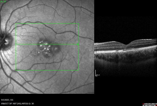 Laser pointer maculopathy
11 year old male When school started the patient noticed that he was having trouble reading and seeing out of both eyes. There are no retinal diseases in the family.
VA OD: sc20/25
VA OS: sc20/40 
TP: OD:19 OS:18 

The FOBSERD ZK-9318 laser pointer is a long range green beam high power flashlight. It has an average power of 60-90 mw. 
You can buy the ZK-9318 laser pointer on Amazon

I also found this:
The FOBSERD ZK-9318 laser pointer is a class III laser with a 532nm wavelength and can be seen up to 1 mile away. It has a maximum power output of 5mW and creates a low-power visible laser beam.

One review on amazon says this:
 Powerful
By Savvy Logic in the United States on March 17, 2023
I measured the wattage at about 150 MW on an optical Power Meter
