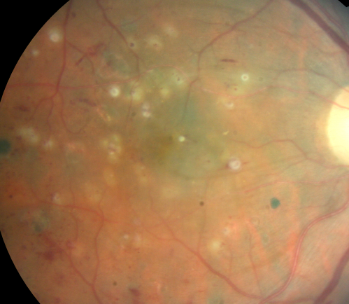 Diabetic and Pseudophakic Cystoid Macular Edema Laser Photo - Focal Laser
56-year-old woman has diabetic retinopathy in both eyes and macular edema.  She is recently pseudophakic.  OD 20/80, OS 20/200.  
Keywords: cme;bdr;pseudophakic;laser;kenalog