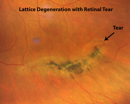 Lattice degeneration with fresh tear - pre-laser
