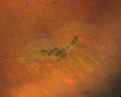 Lattice degeneration with fresh tear - fresh laser - 1 week post treatment
