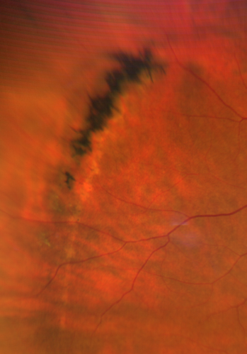 Pigmented Lattice Degeneration
Pigmented Lattice - Incidental Finding
