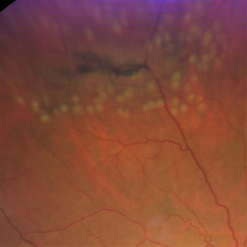 Lattice Degeneration with Tears - Pre and Post laser
60 year old female with new floaters VA is good

