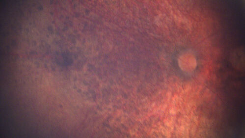 Leber's congenital amaurosis
4 year old child with nystagmus and no evidence of fixation.  Genetic testing showed LCA 9
