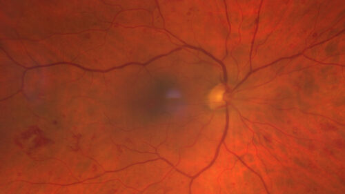 Chronic Myelogenous Leukemia and Diabetic Macular Edema
71 year old female with 3 months of vision loss and not feeling well.  She has been bruising on her legs.  Her vision was 20/100 in each eye with macular edema.  She was treated with Avastin and her CBC was checked.  She had a WBC of 267 thousand and was diagnosed with CML.
