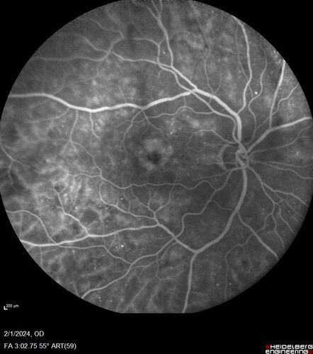 Chronic Myelogenous Leukemia and Diabetic Macular Edema
71 year old female with 3 months of vision loss and not feeling well.  She has been bruising on her legs.  Her vision was 20/100 in each eye with macular edema.  She was treated with Avastin and her CBC was checked.  She had a WBC of 267 thousand and was diagnosed with CML.
