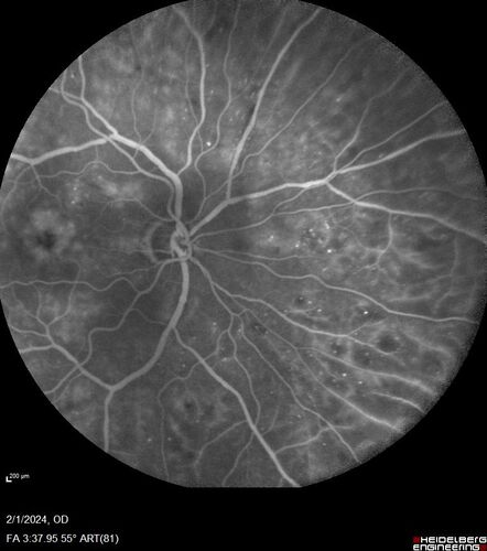 Chronic Myelogenous Leukemia and Diabetic Macular Edema
71 year old female with 3 months of vision loss and not feeling well.  She has been bruising on her legs.  Her vision was 20/100 in each eye with macular edema.  She was treated with Avastin and her CBC was checked.  She had a WBC of 267 thousand and was diagnosed with CML.

