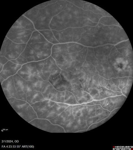 Chronic Myelogenous Leukemia and Diabetic Macular Edema
71 year old female with 3 months of vision loss and not feeling well.  She has been bruising on her legs.  Her vision was 20/100 in each eye with macular edema.  She was treated with Avastin and her CBC was checked.  She had a WBC of 267 thousand and was diagnosed with CML.
