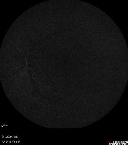 Chronic Myelogenous Leukemia and Diabetic Macular Edema
71 year old female with 3 months of vision loss and not feeling well.  She has been bruising on her legs.  Her vision was 20/100 in each eye with macular edema.  She was treated with Avastin and her CBC was checked.  She had a WBC of 267 thousand and was diagnosed with CML.
