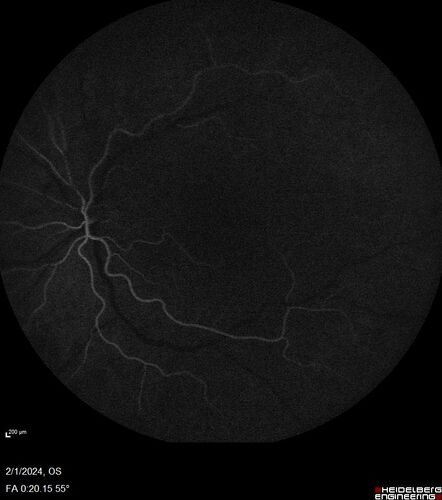 Chronic Myelogenous Leukemia and Diabetic Macular Edema
71 year old female with 3 months of vision loss and not feeling well.  She has been bruising on her legs.  Her vision was 20/100 in each eye with macular edema.  She was treated with Avastin and her CBC was checked.  She had a WBC of 267 thousand and was diagnosed with CML.

