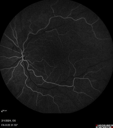 Chronic Myelogenous Leukemia and Diabetic Macular Edema
71 year old female with 3 months of vision loss and not feeling well.  She has been bruising on her legs.  Her vision was 20/100 in each eye with macular edema.  She was treated with Avastin and her CBC was checked.  She had a WBC of 267 thousand and was diagnosed with CML.
