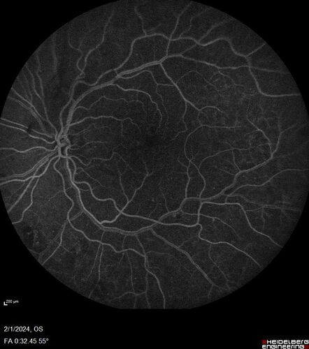 Chronic Myelogenous Leukemia and Diabetic Macular Edema
71 year old female with 3 months of vision loss and not feeling well.  She has been bruising on her legs.  Her vision was 20/100 in each eye with macular edema.  She was treated with Avastin and her CBC was checked.  She had a WBC of 267 thousand and was diagnosed with CML.
