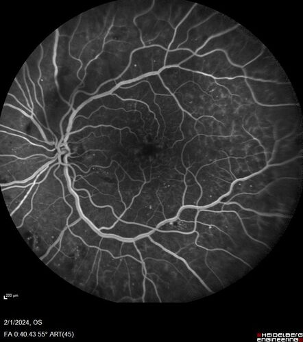 Chronic Myelogenous Leukemia and Diabetic Macular Edema
71 year old female with 3 months of vision loss and not feeling well.  She has been bruising on her legs.  Her vision was 20/100 in each eye with macular edema.  She was treated with Avastin and her CBC was checked.  She had a WBC of 267 thousand and was diagnosed with CML.
