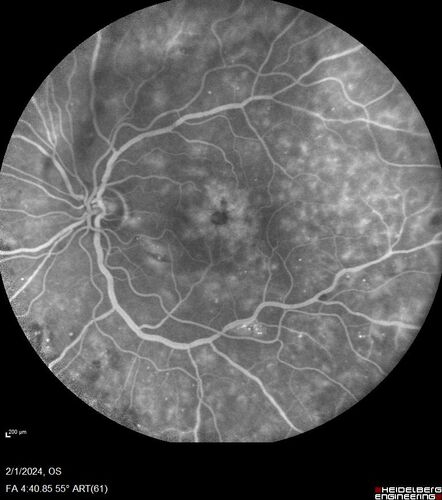 Chronic Myelogenous Leukemia and Diabetic Macular Edema
71 year old female with 3 months of vision loss and not feeling well.  She has been bruising on her legs.  Her vision was 20/100 in each eye with macular edema.  She was treated with Avastin and her CBC was checked.  She had a WBC of 267 thousand and was diagnosed with CML.
