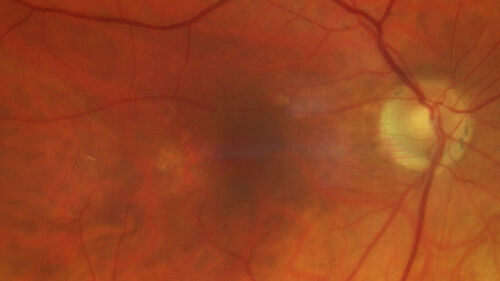 Phototoxicity following cataract surgery
70 year old female with nasal  spot in vision since cataract  surgery 3 years ago.  VA 20/20 OU.
