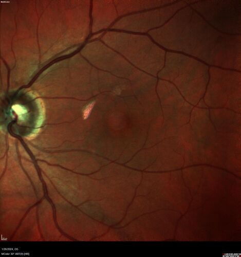Phototoxicity following cataract surgery
70 year old female with nasal  spot in vision since cataract  surgery 3 years ago.  VA 20/20 OU.
