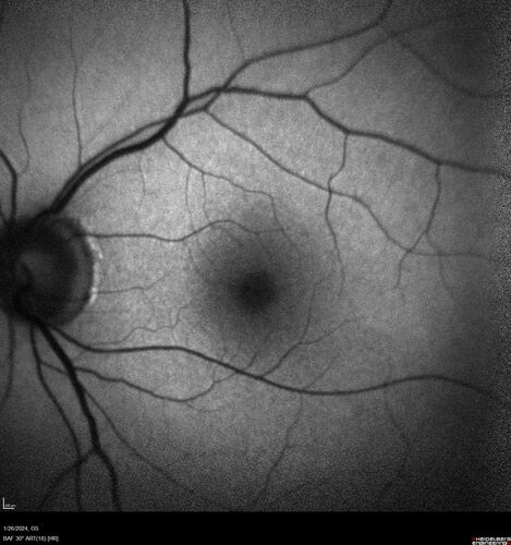 Phototoxicity following cataract surgery
70 year old female with nasal  spot in vision since cataract  surgery 3 years ago.  VA 20/20 OU.
