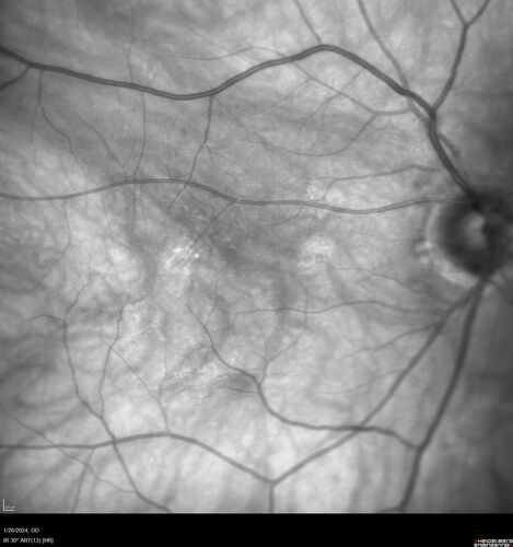 Phototoxicity following cataract surgery
70 year old female with nasal  spot in vision since cataract  surgery 3 years ago.  VA 20/20 OU.
