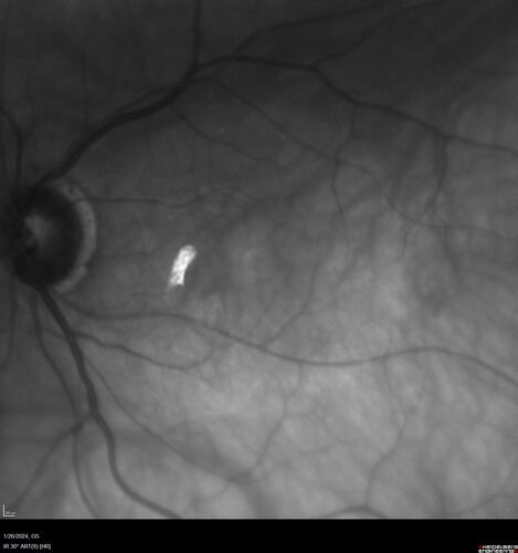 Phototoxicity following cataract surgery
70 year old female with nasal  spot in vision since cataract  surgery 3 years ago.  VA 20/20 OU.
