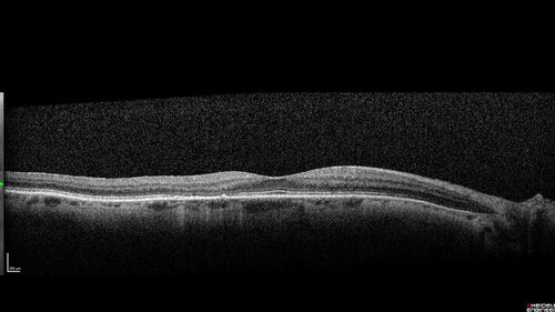Phototoxicity following cataract surgery
70 year old female with nasal  spot in vision since cataract  surgery 3 years ago.  VA 20/20 OU.
