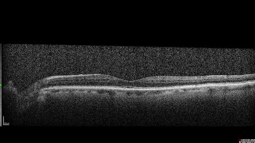 Phototoxicity following cataract surgery
70 year old female with nasal  spot in vision since cataract  surgery 3 years ago.  VA 20/20 OU.
