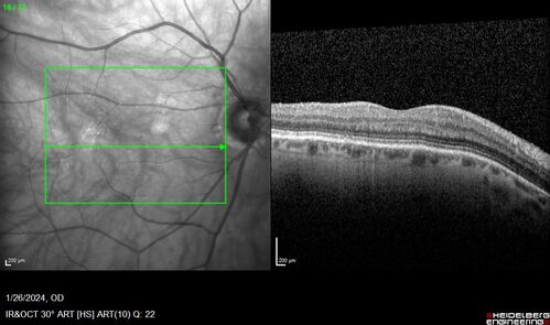 Phototoxicity following cataract surgery
70 year old female with nasal  spot in vision since cataract  surgery 3 years ago.  VA 20/20 OU.
