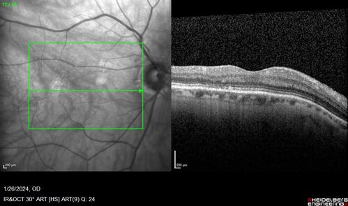 Phototoxicity following cataract surgery
70 year old female with nasal  spot in vision since cataract  surgery 3 years ago.  VA 20/20 OU.
