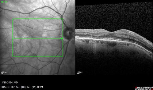 Phototoxicity following cataract surgery
70 year old female with nasal  spot in vision since cataract  surgery 3 years ago.  VA 20/20 OU.
