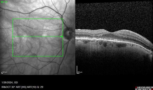 Phototoxicity following cataract surgery
70 year old female with nasal  spot in vision since cataract  surgery 3 years ago.  VA 20/20 OU.
