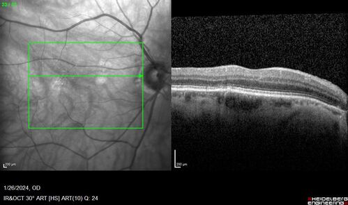 Phototoxicity following cataract surgery
70 year old female with nasal  spot in vision since cataract  surgery 3 years ago.  VA 20/20 OU.

