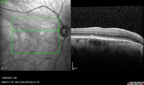 Phototoxicity following cataract surgery
70 year old female with nasal  spot in vision since cataract  surgery 3 years ago.  VA 20/20 OU.
