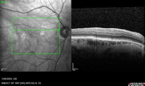 Phototoxicity following cataract surgery
70 year old female with nasal  spot in vision since cataract  surgery 3 years ago.  VA 20/20 OU.
