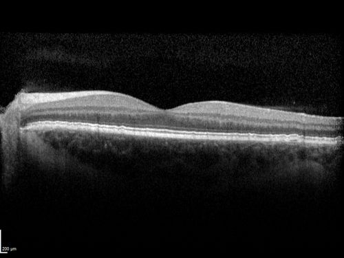 Basal Laminar Drusen - Cuticular Drusen - 19 Year Old with Lupus Nephritis
19-year-old.  She has a history of developing severe systemic lupus erythematosus in 2001.  She was in renal failure and had biopsy proven Class 2 lupus nephritis.  She is currently on Plaquenil 400 mg for six years, as well as Prednisolone orally, every other day. OD 20/20, OS 20/25.
