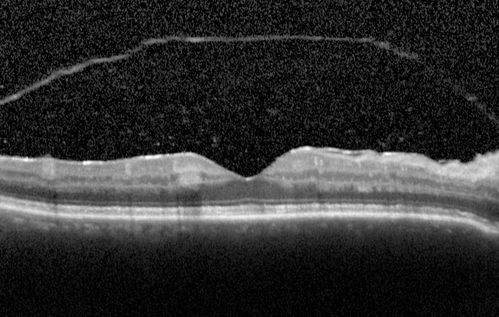 Birdshot Chorioretintis and PAMM
Patient presented with paracentral acute middle maculopathy as the presenting symptom of birdshot.  This case was published. RETINAL CASES & BRIEF REPORTS 10:151â€“153, 2016.
