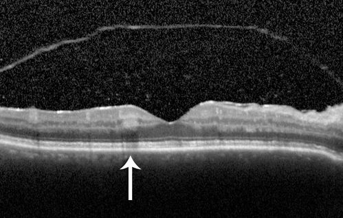 Birdshot Chorioretintis and PAMM
Patient presented with paracentral acute middle maculopathy as the presenting symptom of birdshot.  This case was published. RETINAL CASES & BRIEF REPORTS 10:151â€“153, 2016.
