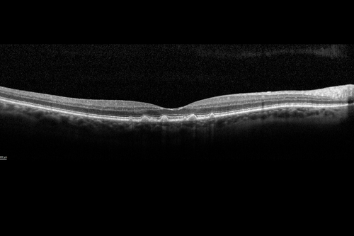 Central Retinal Artery Occlusion with Cilioretinal Sparing - Acute - Line scan good eye
 77-year-old man was doing fine until midnight of last night when he noticed sudden severe vision loss in the left eye. VISUAL ACUITY:  OD 20/20,  OS 2/200.
