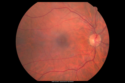 Serous Retinal Detachment - Hypertensive Retinopathy - 165/120 
48-year-old woman noticed when she was blinking there was a white flash in the left eye starting about a month ago.  She sees it temporally.  OD 20/16,  OS 20/20.  There is a serous retinal detachment superotemporal to the optic nerve falling short of the fovea.   Her blood pressure 165/120. 
