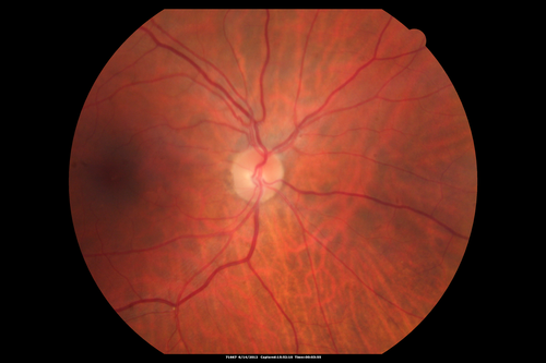 Serous Retinal Detachment - Hypertensive Retinopathy - 165/120 
48-year-old woman noticed when she was blinking there was a white flash in the left eye starting about a month ago.  She sees it temporally.  OD 20/16,  OS 20/20.  There is a serous retinal detachment superotemporal to the optic nerve falling short of the fovea.   Her blood pressure 165/120. 
