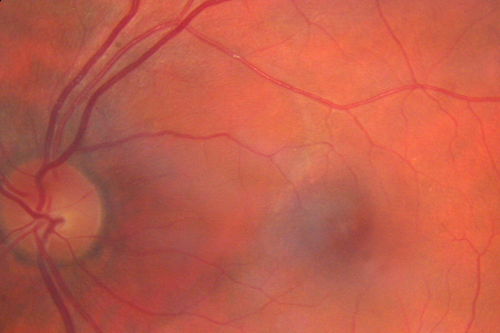 Serous Retinal Detachment - Hypertensive Retinopathy - 165/120 
48-year-old woman noticed when she was blinking there was a white flash in the left eye starting about a month ago.  She sees it temporally.  OD 20/16,  OS 20/20.  There is a serous retinal detachment superotemporal to the optic nerve falling short of the fovea.   Her blood pressure 165/120. 
