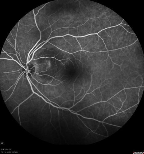 Serous Retinal Detachment - Hypertensive Retinopathy - 165/120 - Fluorescein Angiogram
48-year-old woman noticed when she was blinking there was a white flash in the left eye starting about a month ago.  She sees it temporally.  OD 20/16,  OS 20/20.  There is a serous retinal detachment superotemporal to the optic nerve falling short of the fovea.   Her blood pressure 165/120. 
