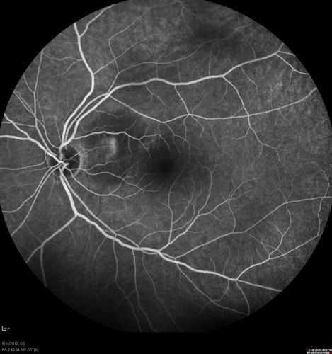 Serous Retinal Detachment - Hypertensive Retinopathy - 165/120 - Fluorescein Angiogram
48-year-old woman noticed when she was blinking there was a white flash in the left eye starting about a month ago.  She sees it temporally.  OD 20/16,  OS 20/20.  There is a serous retinal detachment superotemporal to the optic nerve falling short of the fovea.   Her blood pressure 165/120. 

