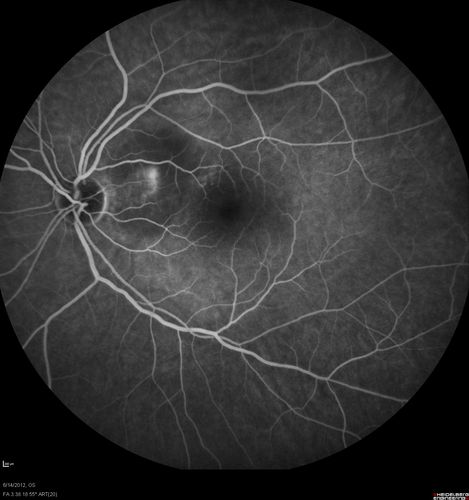 Serous Retinal Detachment - Hypertensive Retinopathy - 165/120 - Fluorescein Angiogram
48-year-old woman noticed when she was blinking there was a white flash in the left eye starting about a month ago.  She sees it temporally.  OD 20/16,  OS 20/20.  There is a serous retinal detachment superotemporal to the optic nerve falling short of the fovea.   Her blood pressure 165/120. 

