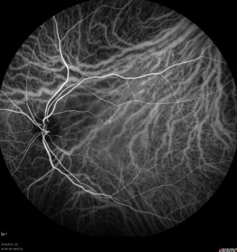 Serous Retinal Detachment - Hypertensive Retinopathy - 165/120 - Indocyanine Green Angiogram
48-year-old woman noticed when she was blinking there was a white flash in the left eye starting about a month ago.  She sees it temporally.  OD 20/16,  OS 20/20.  There is a serous retinal detachment superotemporal to the optic nerve falling short of the fovea.   Her blood pressure 165/120. 
