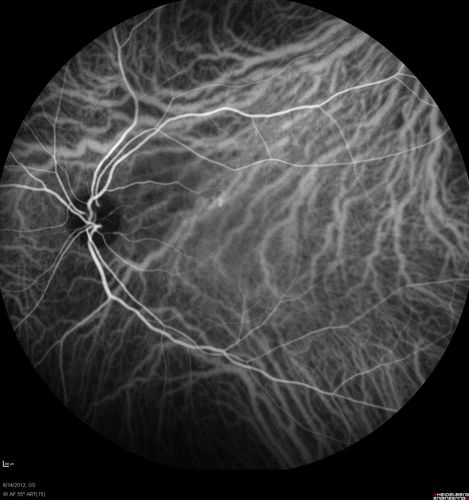 Serous Retinal Detachment - Hypertensive Retinopathy - 165/120 - Indocyanine Green Angiogram
48-year-old woman noticed when she was blinking there was a white flash in the left eye starting about a month ago.  She sees it temporally.  OD 20/16,  OS 20/20.  There is a serous retinal detachment superotemporal to the optic nerve falling short of the fovea.   Her blood pressure 165/120. 
