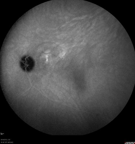 Serous Retinal Detachment - Hypertensive Retinopathy - 165/120 - Late - ICG shows leakage
48-year-old woman noticed when she was blinking there was a white flash in the left eye starting about a month ago.  She sees it temporally.  OD 20/16,  OS 20/20.  There is a serous retinal detachment superotemporal to the optic nerve falling short of the fovea.   Her blood pressure 165/120. 
