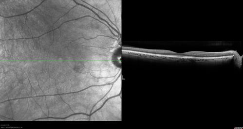 Serous Retinal Detachment - Hypertensive Retinopathy -- 1 month later - less fluid (better blood pressure)
48 Year old woman resolving hypertensive serous retinal detachment.
